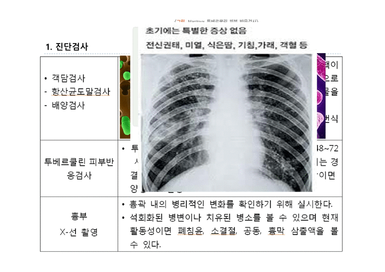 폐결핵 - 폐결핵이란 - 의약학
