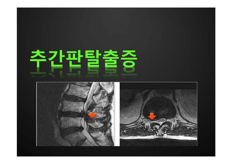 추간판탈출증 레포트 - 의약학