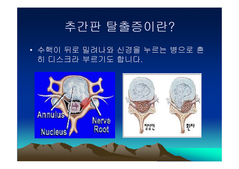 통증의학 - 척추 추간판 탈출증 - 의약학