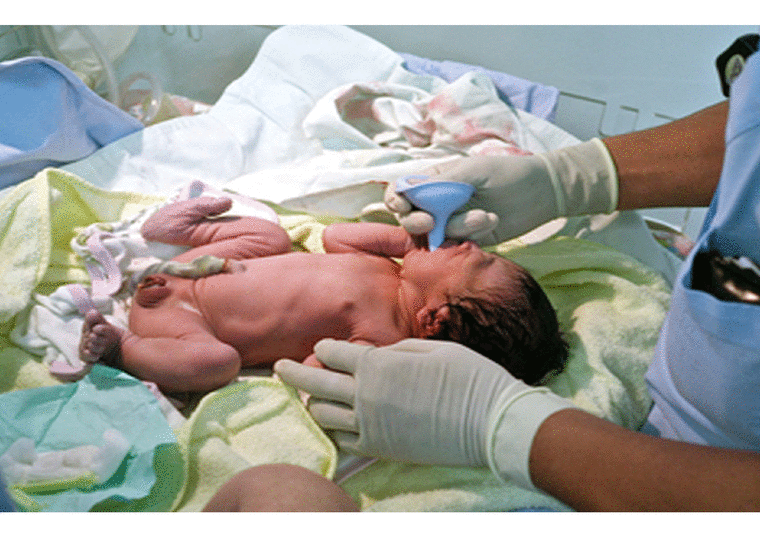 Neonatal Suction 