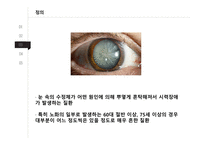 발표 PPT/4.5(A+) 자료  백내장(cataract)-6페이지