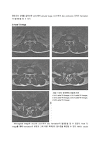 PBL  추간판 탈출증의 MRI 와 CT 상의 소견 차이-5페이지