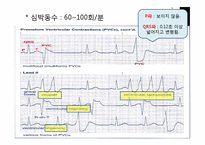 건강과 간호  동성리듬  EKG 리듬 PBL-14페이지