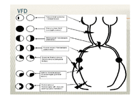 뇌손상 - Neglect & VFD Visual Field Deficit 에 대해서 - 의약학