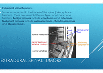PBL  척수종양(Spinal cord tumors)-3페이지
